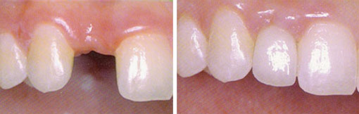 Dental Implants before after