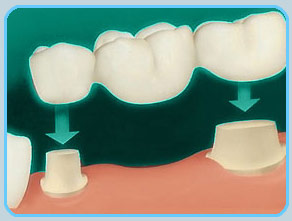 dental bridge torgersen dental