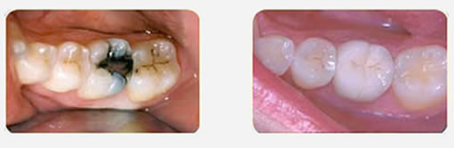 Crown torgersen dental