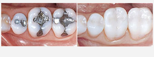 amalgam and white composite dental filling