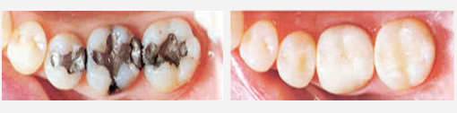 amalgam and white composite dental filling