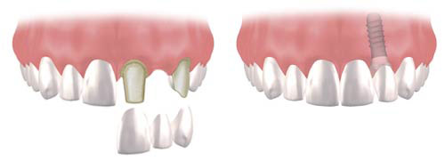 Dental Implants