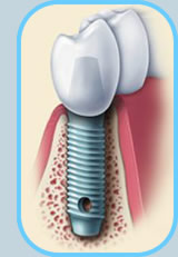 dental implant model