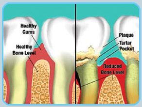 Periodontal Treatment