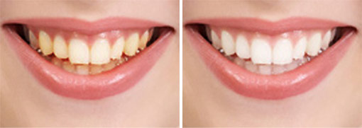teeth whitening at torgersen dental before after