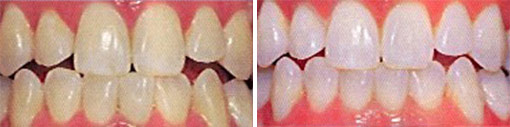 teeth whitening at torgersen dental
