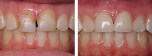 dental veneers before after2