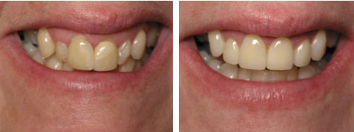 dental veneers before after1
