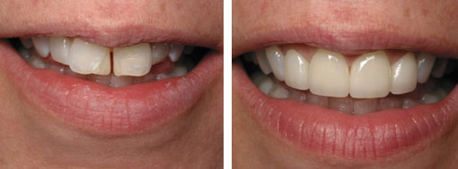 dental veneers before after3